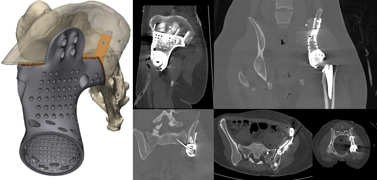 Magicwandmedia_'s tweet photo. Today, a combination of additive manufacturing and CT imaging is making it possible to create truly customized prostheses. At the cutting edge of this technology is MT Ortho, based in Sicily. @GEAdditive @MTortho #additivemanufacturing #medicalmachining
https://t.co/laTzoAo9SL https://t.co/fx4oGXM2xA