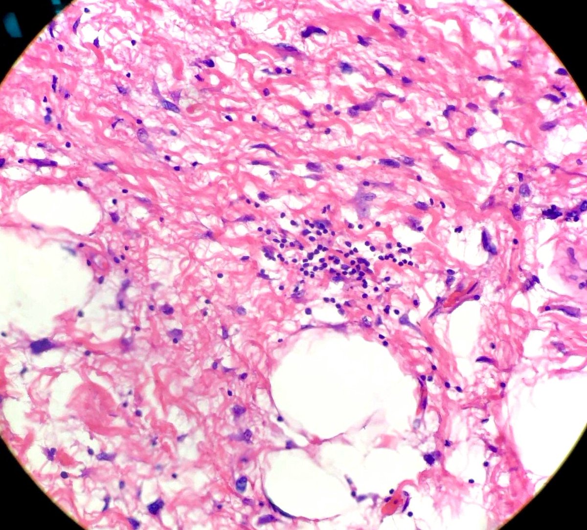 thejourneymate's tweet photo. When To Suspect Atypical Lipomatous Tumor/Well Differentiated Liposarcoma ☝
✅Large and deep tumor (comes in buckets!)
✅Retroperitoneal
✅MRI heterogeneity
✅Fibrous bands
✅Atypia at LPO
* Don’t look for lipoblasts!
#BSTPath
(The Trouble with Fat, John Goldblum 2016) https://t.co/lT1HSmlw7d