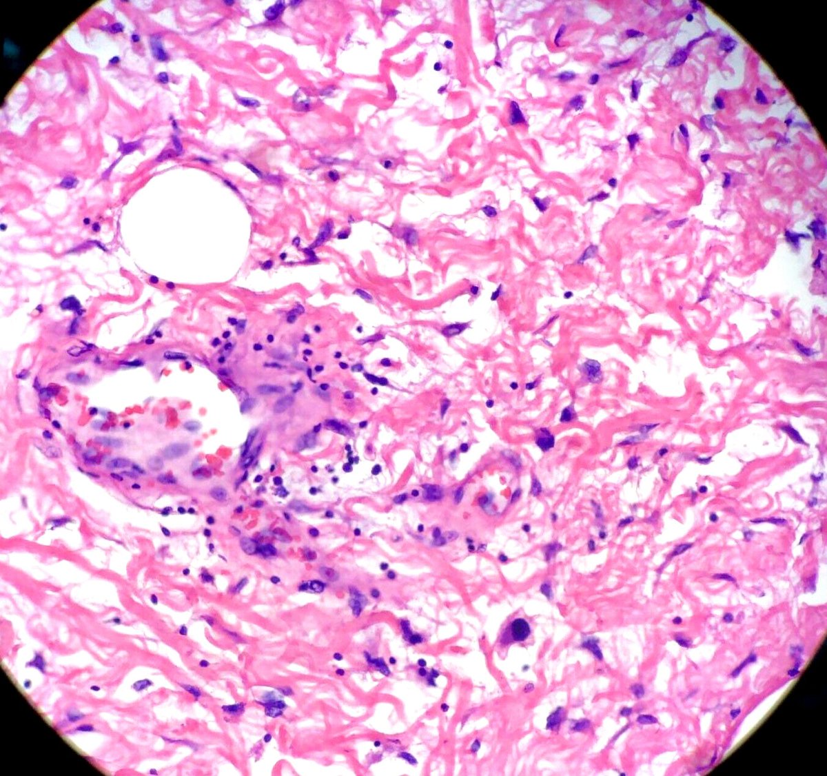 thejourneymate's tweet photo. When To Suspect Atypical Lipomatous Tumor/Well Differentiated Liposarcoma ☝
✅Large and deep tumor (comes in buckets!)
✅Retroperitoneal
✅MRI heterogeneity
✅Fibrous bands
✅Atypia at LPO
* Don’t look for lipoblasts!
#BSTPath
(The Trouble with Fat, John Goldblum 2016) https://t.co/lT1HSmlw7d