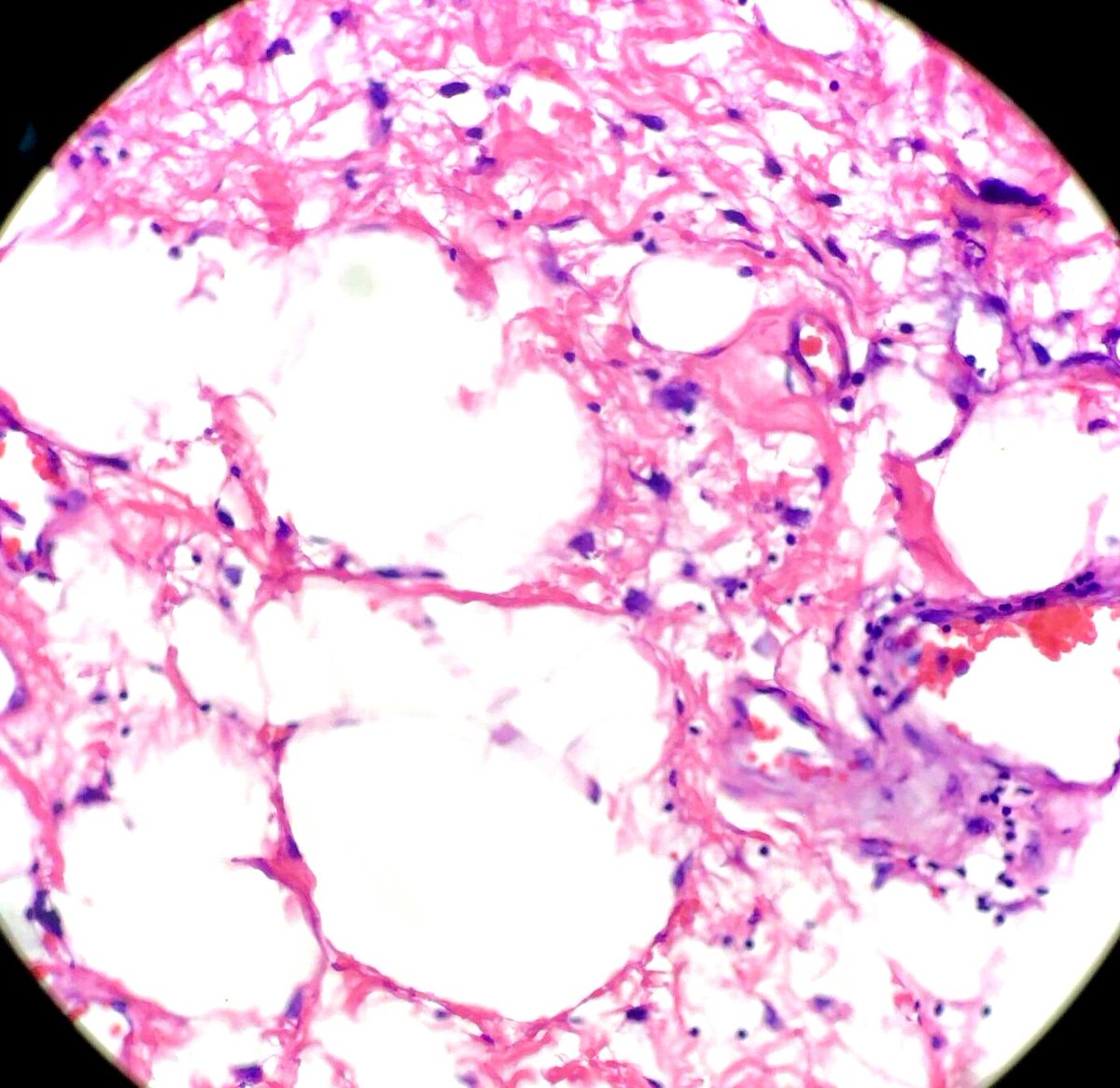 thejourneymate's tweet photo. When To Suspect Atypical Lipomatous Tumor/Well Differentiated Liposarcoma ☝
✅Large and deep tumor (comes in buckets!)
✅Retroperitoneal
✅MRI heterogeneity
✅Fibrous bands
✅Atypia at LPO
* Don’t look for lipoblasts!
#BSTPath
(The Trouble with Fat, John Goldblum 2016) https://t.co/lT1HSmlw7d
