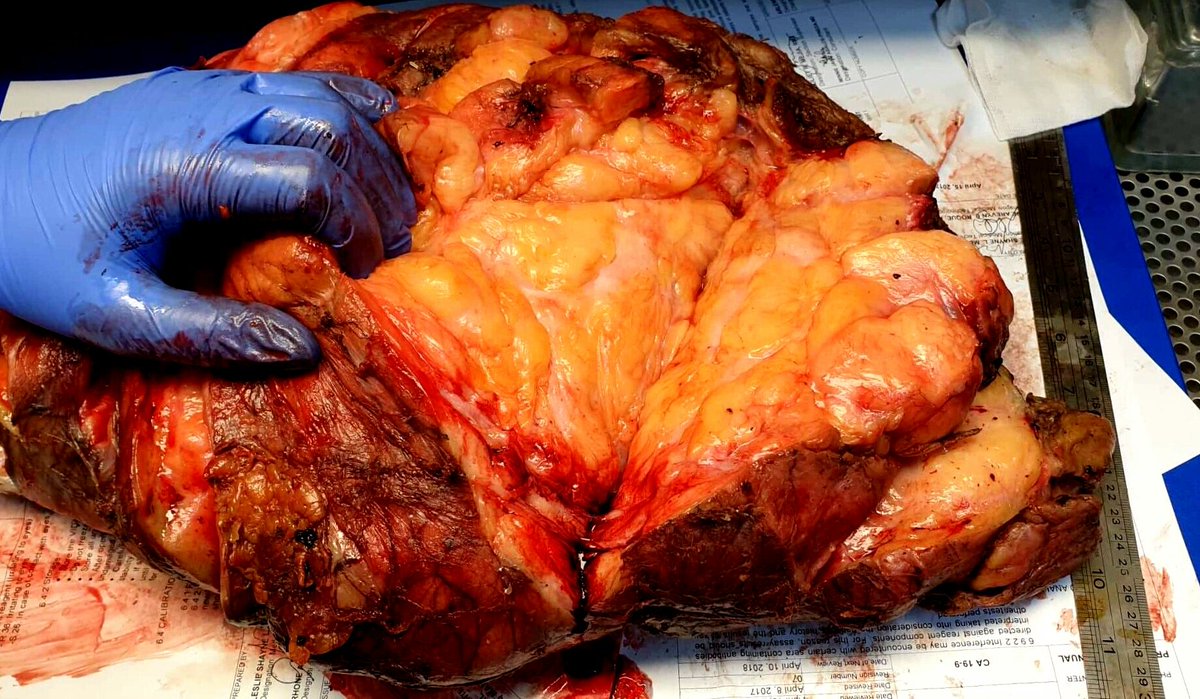 thejourneymate's tweet photo. When To Suspect Atypical Lipomatous Tumor/Well Differentiated Liposarcoma ☝
✅Large and deep tumor (comes in buckets!)
✅Retroperitoneal
✅MRI heterogeneity
✅Fibrous bands
✅Atypia at LPO
* Don’t look for lipoblasts!
#BSTPath
(The Trouble with Fat, John Goldblum 2016) https://t.co/lT1HSmlw7d