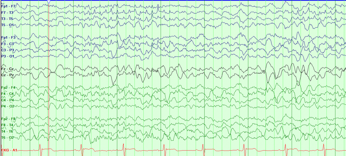 These can be easily missed on bipolar montages, especially if electrodes are too close to each other (given broad distribution). It's a good idea to confirm on a contralateral ear montage. Look at the difference of my 6 Hz variant this morning on double banana vs. contralat ear: