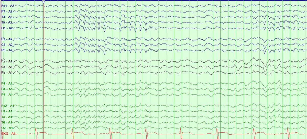 These can be easily missed on bipolar montages, especially if electrodes are too close to each other (given broad distribution). It's a good idea to confirm on a contralateral ear montage. Look at the difference of my 6 Hz variant this morning on double banana vs. contralat ear: