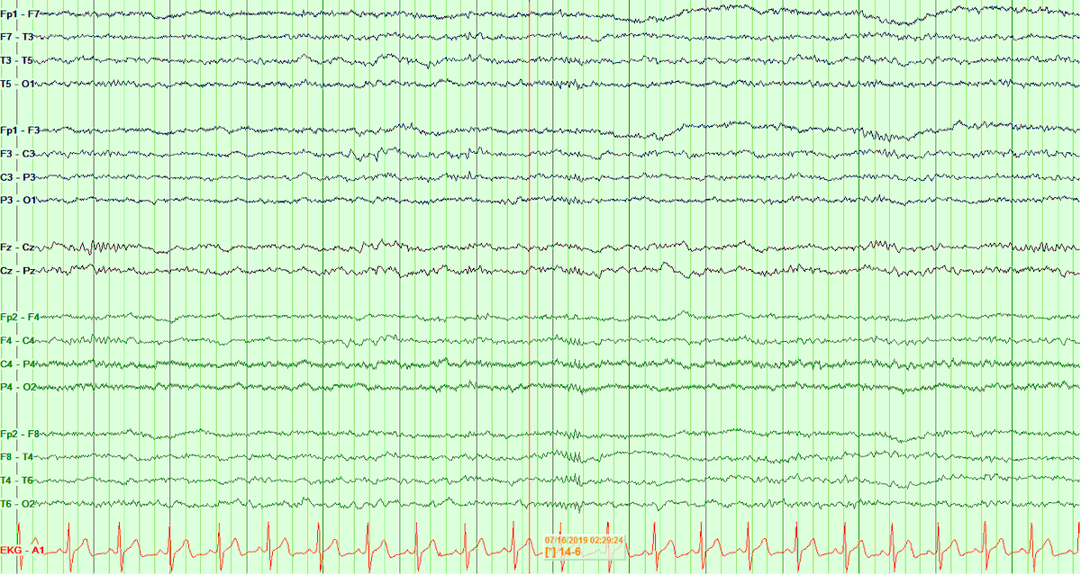 This morning, I tried "average ears" or "ears tied" referential (which tbh I never use), just for kicks... it actually really enhanced the 14 Hz variant. Compare it with longitudinal bipolar montage: