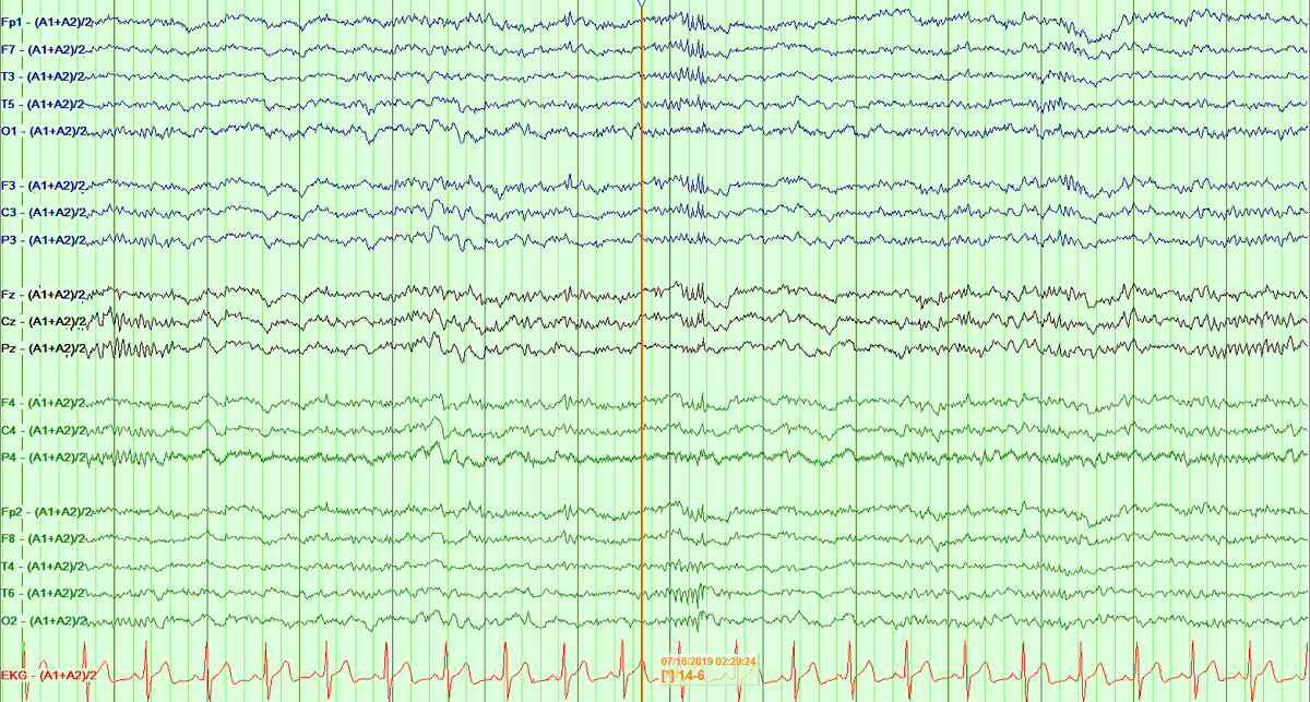 This morning, I tried "average ears" or "ears tied" referential (which tbh I never use), just for kicks... it actually really enhanced the 14 Hz variant. Compare it with longitudinal bipolar montage: