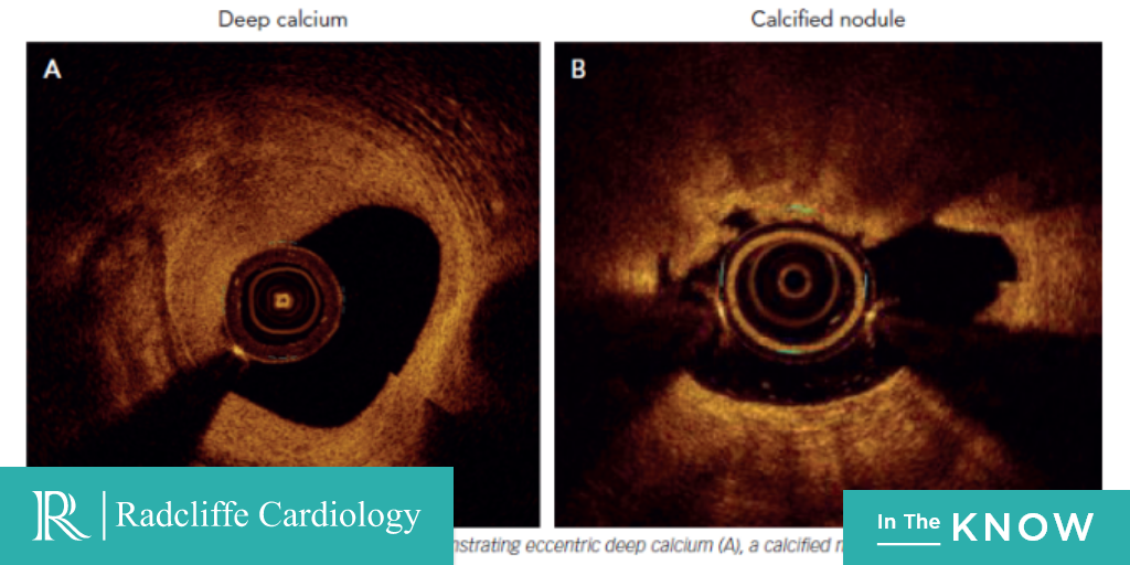 radcliffeCARDIO's tweet image. Could imaging &amp;amp; ablative technologies change the way cases of calcific coronary artery disease are treated? A comprehensive understanding of these complex lesions might be just around the corner 👉 ow.ly/YAiU50AMrHg by @agtruesdell @matheenkhuddus @saraceciliamtz @ESHLOF