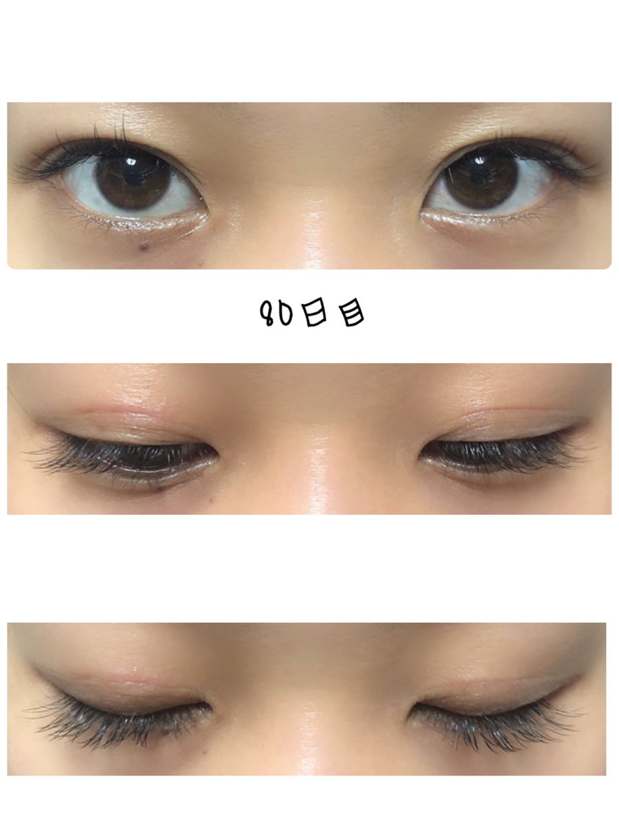 る マツエクつけました 二重切開 二重整形 部分切開 る マツエクつけました 二重切開 二重整形 部分切開