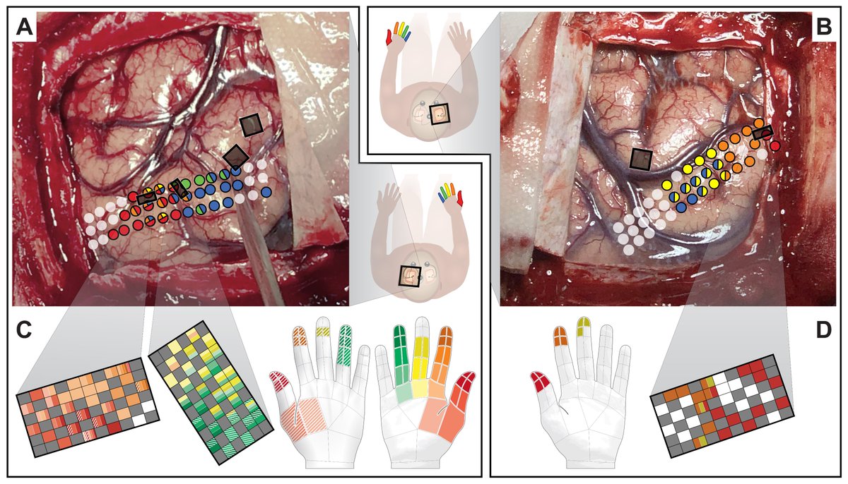 We utilized hd ECoG arrays + peripheral hand stimulation (A/B) to map finger/tip sensory area intraoperatively, leading to accurate placement of our sensory MEAs for ICMS (C/D) (2/n)