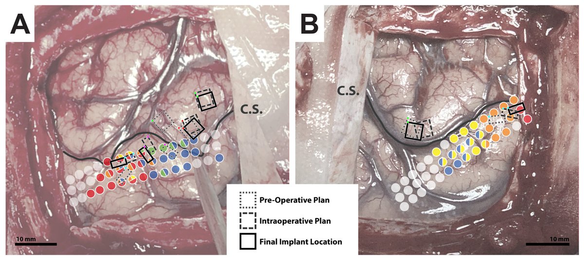 So, was all this awake intraop mapping worth it? We think so! (see Fig. 1 coverage maps above) In this figure, you can see the shift in brain target from preop to intraop/final implant locations, which span different receptive fields. Every mm counts! (10/n)