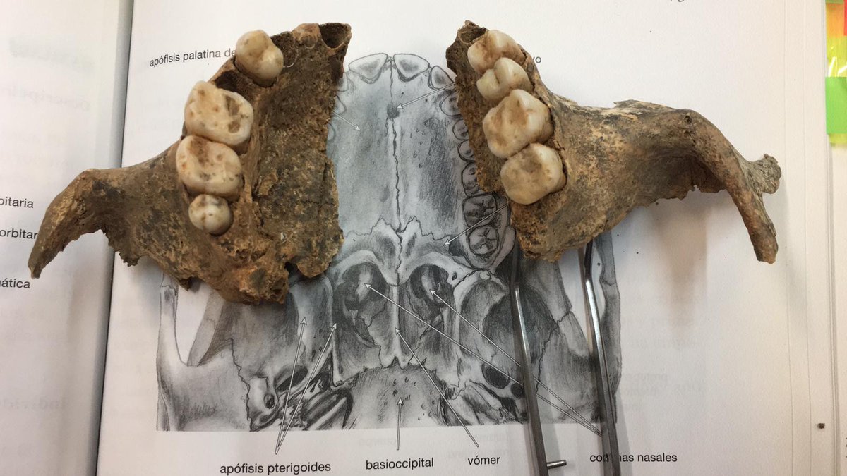 CarmeRissech's tweet photo. Analysing #theteeth of individuals from the #CopperAge of the #Northeast of the #IberianPeninsula in the Ca n'Oliver Museum in Cerdanyola del Vallès (Barcelona). https://t.co/30b4x02N2I