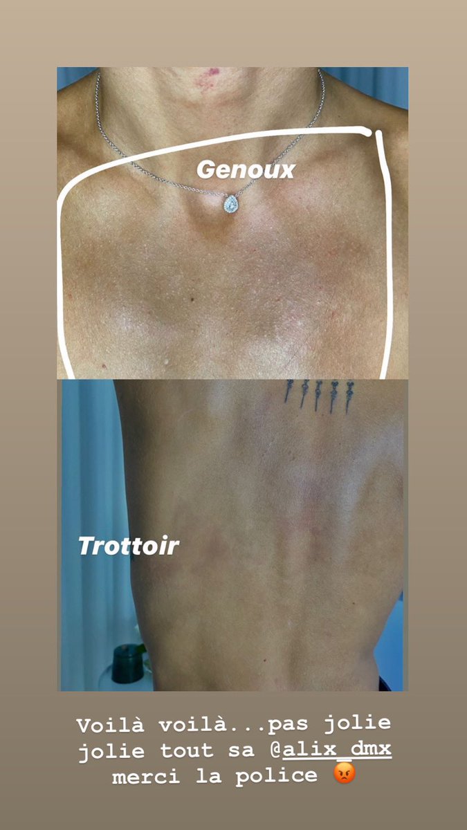 margaux_stefani's tweet photo. @dmx_alix qui nous dévoile les hématomes qu’elle a sur les parties de son corps, il serait peut être temps de réagir...
Partagez un Max !
Soutenons @dmx_alix et ces amis !
#alix #ViolencesPolicieres #hematome #Police #Espagne #justice https://t.co/pB3a58RqLc