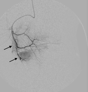 JVIR (@jvirmedia) on Twitter photo Genicular Artery Embolization for the Treatment of Knee Pain Secondary to Osteoarthritis | ow.ly/I1vZ50AlHry #irad <a href="/SandeepBaglaMD/">Sandeep Bagla MD</a> Genicular Artery Embolization for the Treatment of Knee Pain Secondary to Osteoarthritis | ow.ly/I1vZ50AlHry #irad <a href="/SandeepBaglaMD/">Sandeep Bagla MD</a>