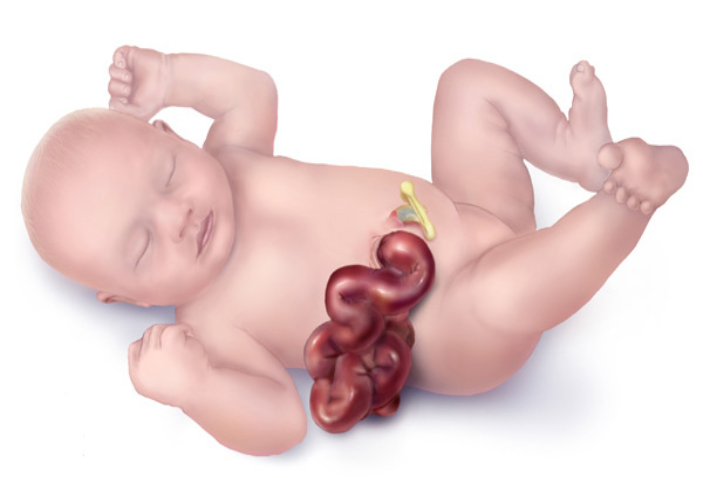 CDC_NCBDDD's tweet photo. #Gastroschisis is a birth defect of the belly that affects 2,000+ babies born in the US every year. These babies can have problems with nursing/eating, digestion, &amp; absorption of nutrients. Learn more:  https://t.co/qSqZqzUvka. https://t.co/o9qbkVFNPf