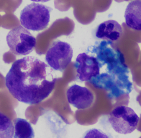 sanamloghavi's tweet photo. A Presidential Debate in the bone marrow... The red one  looks pretty deranged to me..  #redversusblue  #hemepath https://t.co/oBduYCExW8