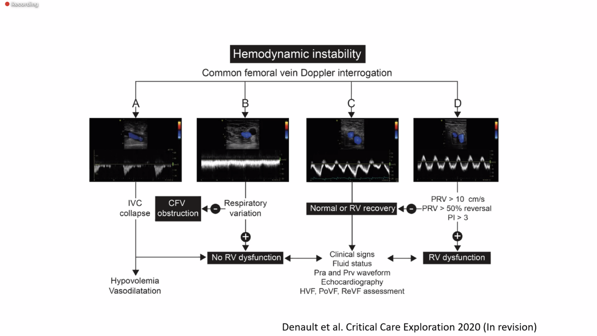 srrezaie's tweet photo. Fastest Way to Diagnose RV Dysfunction via Andre Denault

-Linear Probe
-Pulsatile venous doppler flow of CFV
-Increased pulsatility signifies increased rt atrial pressure
-No Femoral pulsatility ≠ Volume
-Femoral pulsatility ≠ Lasix

#FOAMed #FOAMcc #HRreloaded https://t.co/TjZDXBGpEe