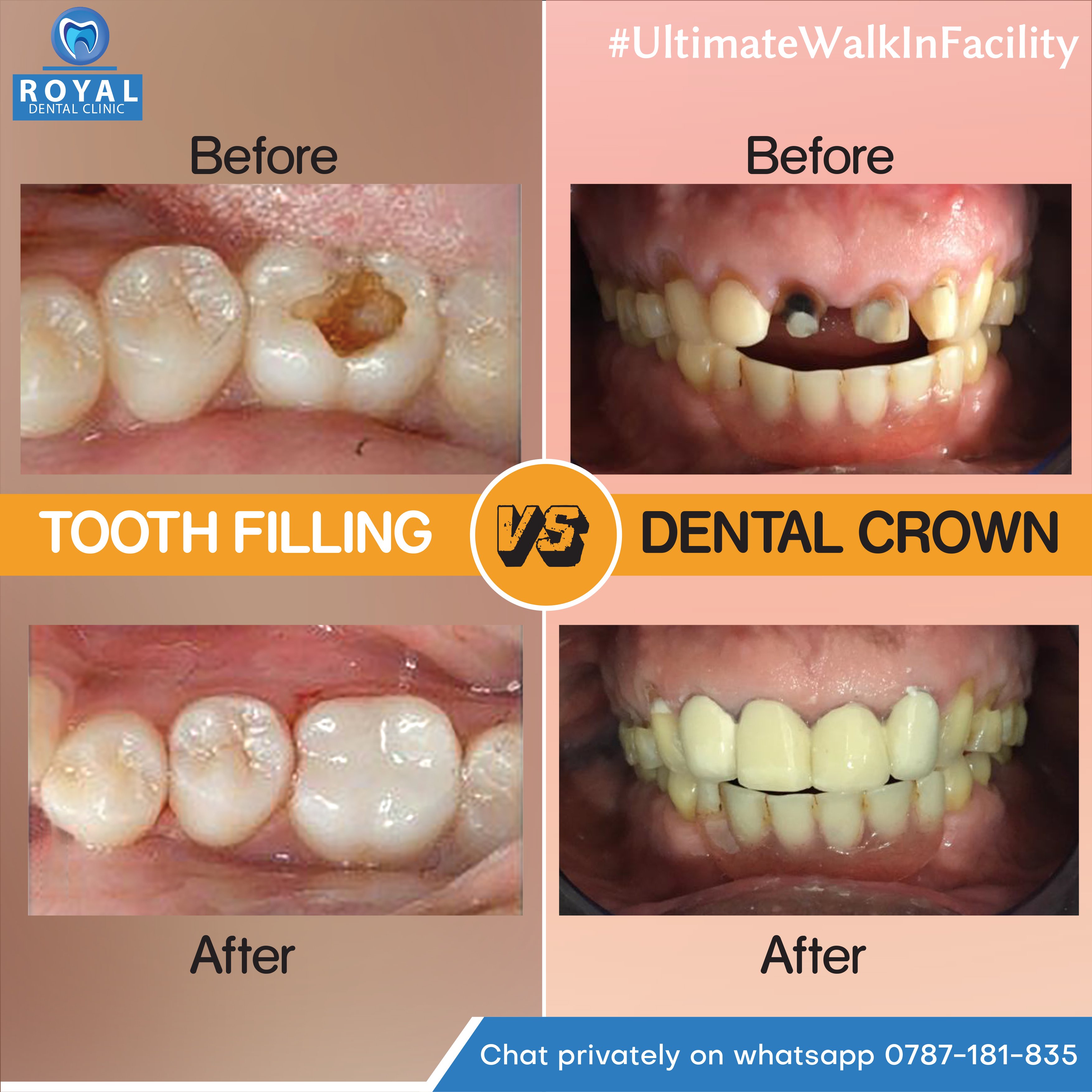 Broken Molar Filling