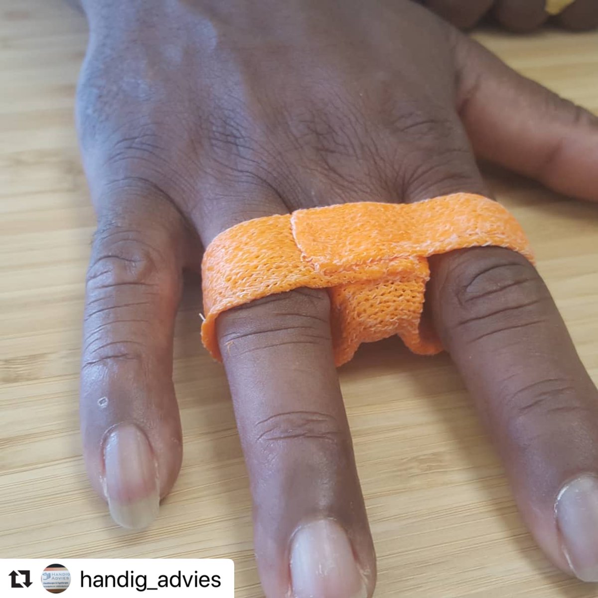 Orfit's tweet photo. Excellent orthosis for amputation management! This orange #Orficast orthosis normalizes the movement pattern and promotes flexion in MCP Joint 3. 

A colorful solution by @handig_advies that reduces pain and allows the patient to continue its daily activities. 

#FingerAmputee https://t.co/AOnYt5MpJJ