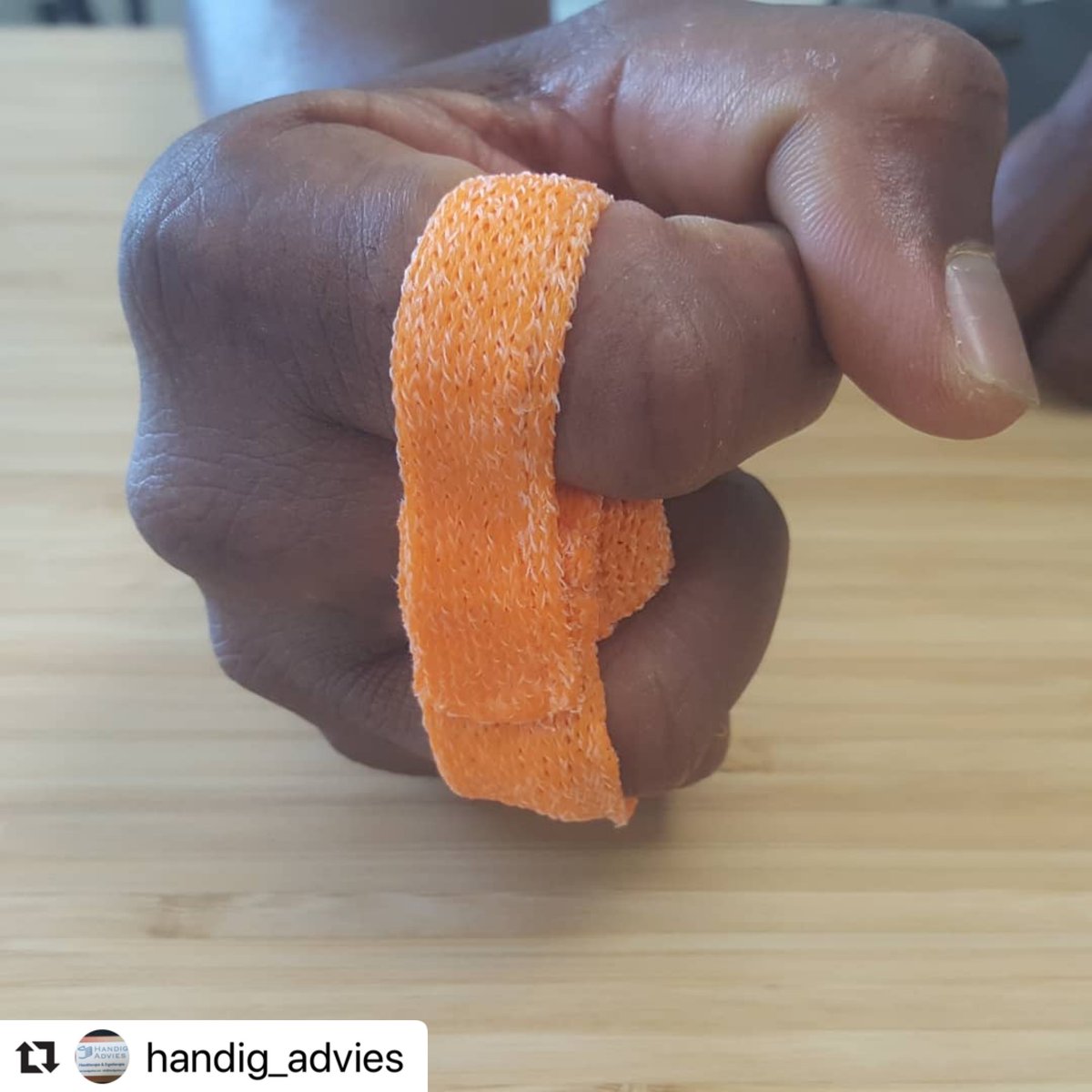 Orfit's tweet photo. Excellent orthosis for amputation management! This orange #Orficast orthosis normalizes the movement pattern and promotes flexion in MCP Joint 3. 

A colorful solution by @handig_advies that reduces pain and allows the patient to continue its daily activities. 

#FingerAmputee https://t.co/AOnYt5MpJJ