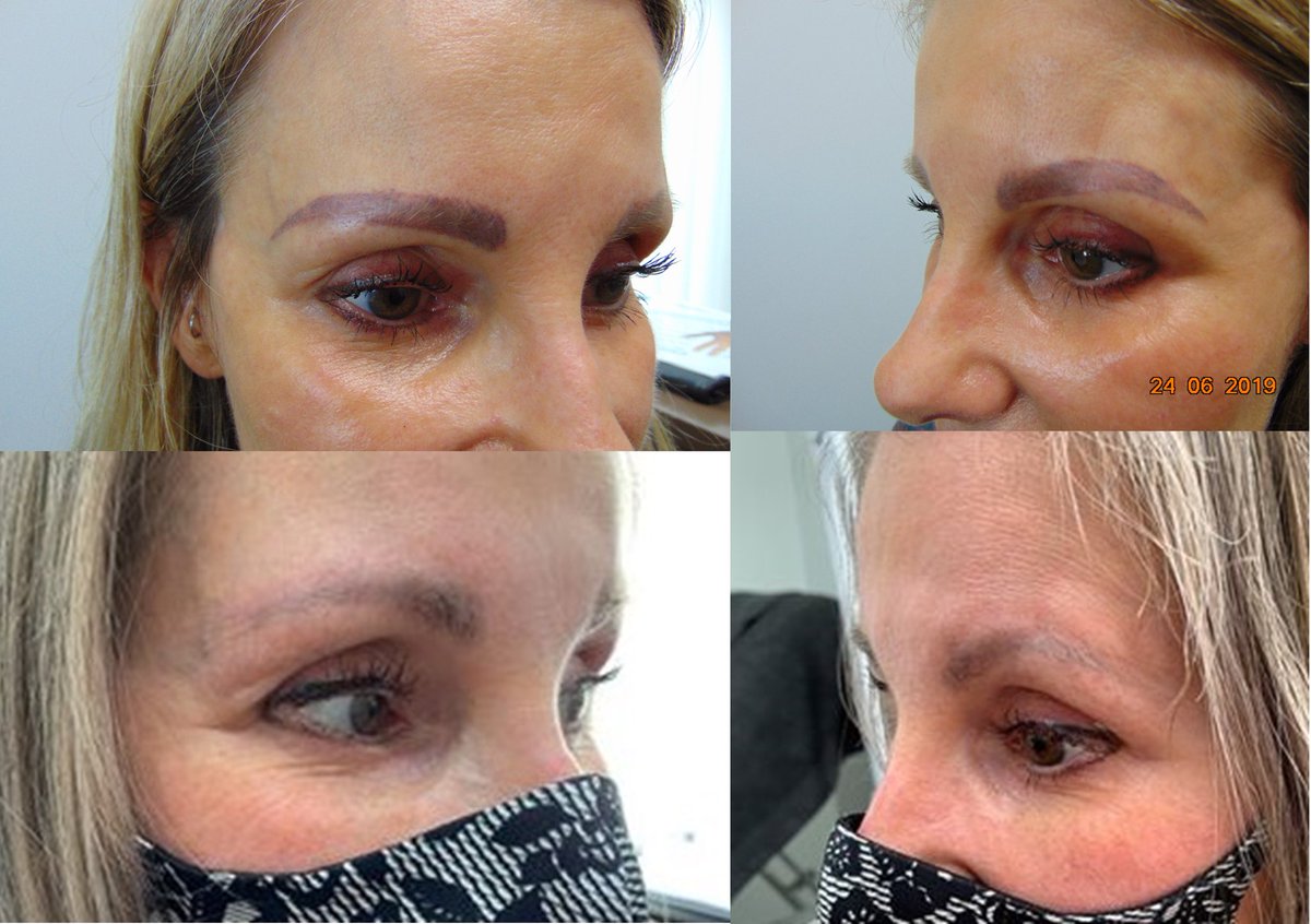 Dodgy eyebrows? Eyebrow correction is one of our specialities #eyebrowcorrection #tattooremoval