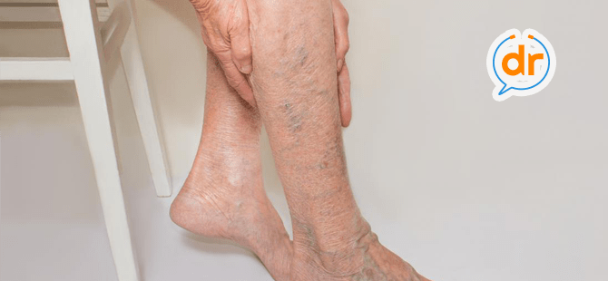 Apakah Sobat memiliki varises vena ? Ketahui lebih lanjut mengenai penyakit ini ya Sobat : buff.ly/34FTjt9. #varisesvena