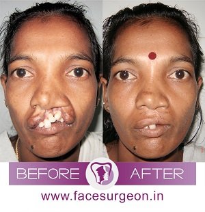 AndeiSoI's tweet photo. Adult cleft Repair Surgery #adultcleft #cleftrepair #facesurgery #maxfax #beforeafter #MedTwitter. 

Satisfaction is seeing great results 🙂🙂 https://t.co/t6YI6AMyJE