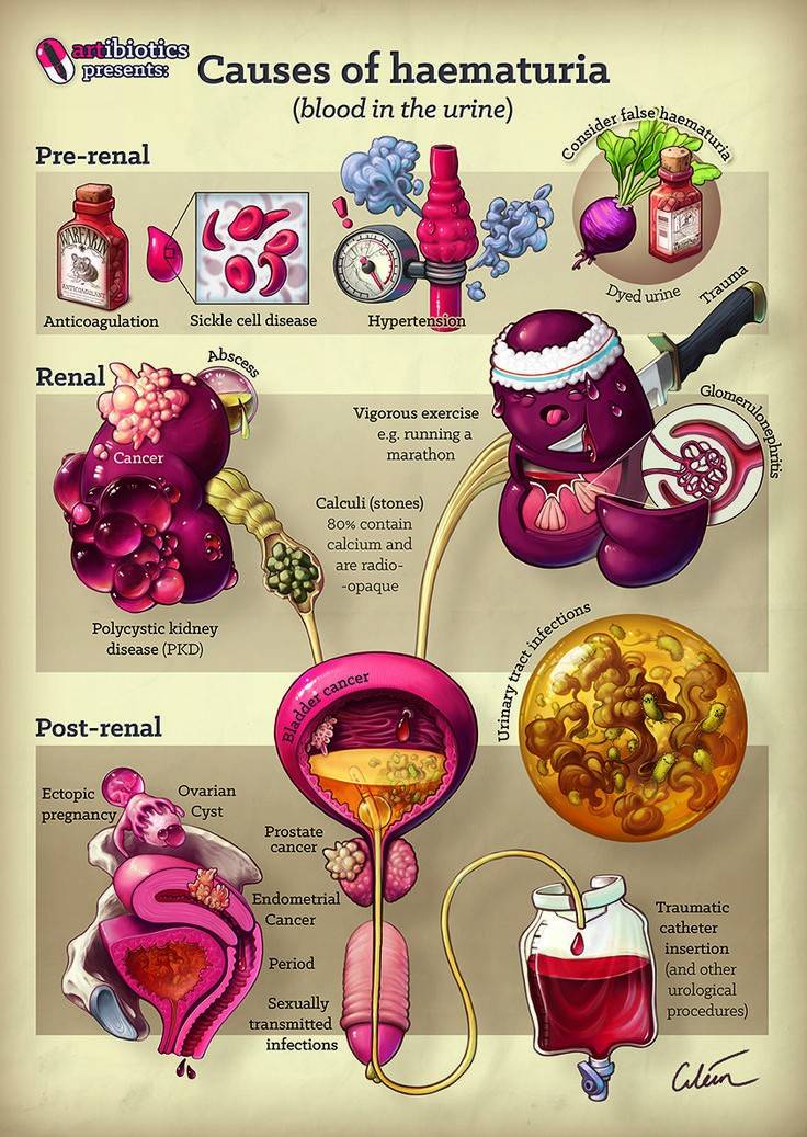Dr. Sumiya 💉 on Twitter: "Цусаар шээхийг гематури гэж нэрлэдэг ...