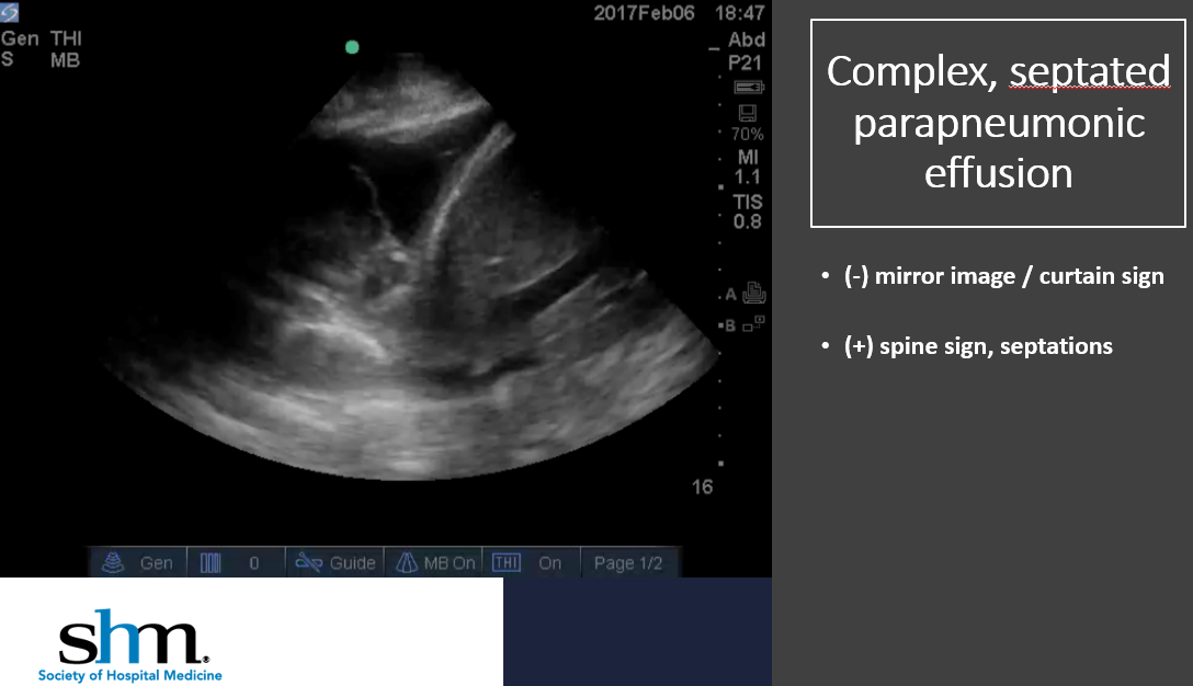 2/ Stephen Ferraro, MS4 from  @UWMedicine presented a case on 'Septated Development'. Dr. Zhang  @IMUS_Spokane provided faculty discussionClinical exam + POCUS = powerhouse tool!Septations = marker of badness Serial POCUS: helps guide progression, & thoracentesis