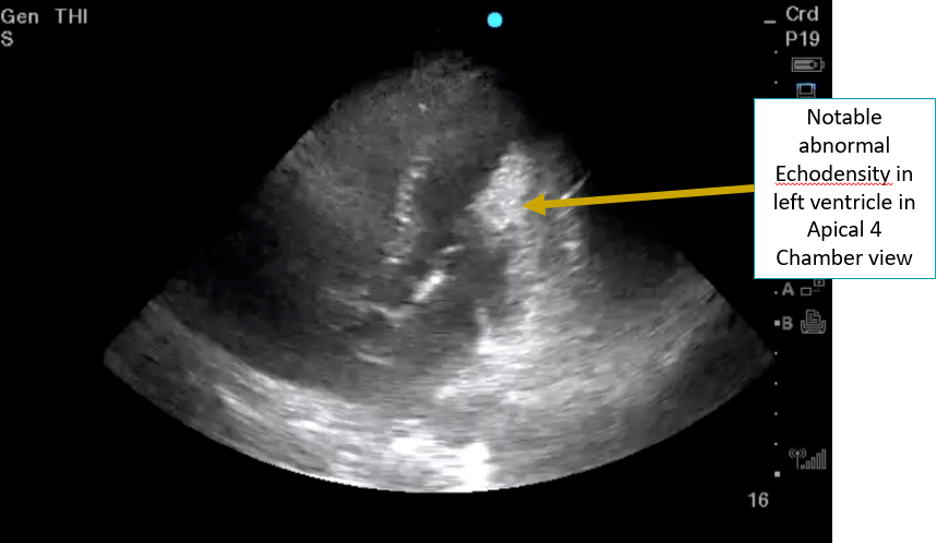 7/ Dr. Kwan  @UNC_SOM presented with Dr.  @ria_dancel providing discussionCommon cardiac mass-like structures include thrombi & vegetations – 2 conditions should not rule out with POCUS but could rule in if grossly abnormal. Moderator band & trabeculations often mimics!