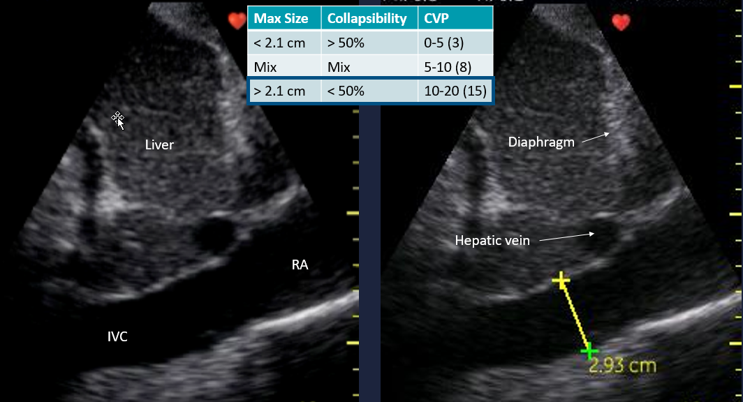 8/ Dr. Williams from  @EmoryMedicine presented with Dr.  @bboesch providing discussionMove from “Can you scan the IVC for volume status?” to “Can you evaluate volume status with POCUS?”IVC = RAP/CVP relationship is good but CVP = volume status is not good.