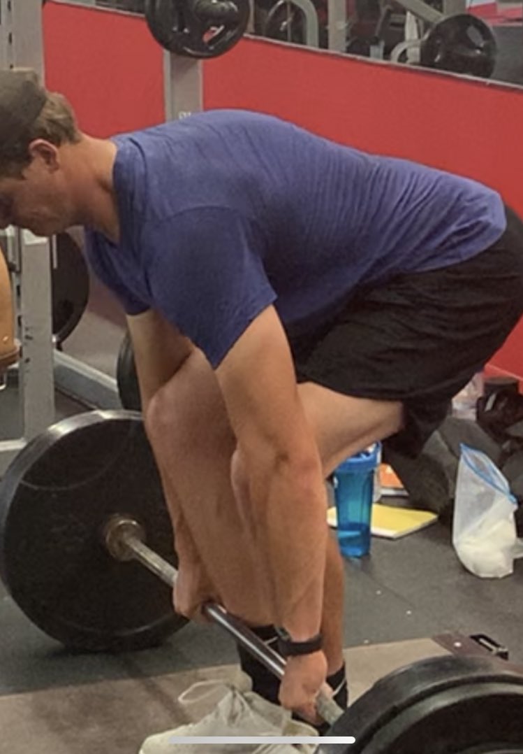 Why I Push Strength Training so hard [Thread] I battle Scheuermans Kyohosis which is Hyperkyphosis of the thoracic spine. (Can see in image below)It’s genetic.Basically wedging of vertebrae in my upper back. I had terrible back pain from age 15-17 due to this.