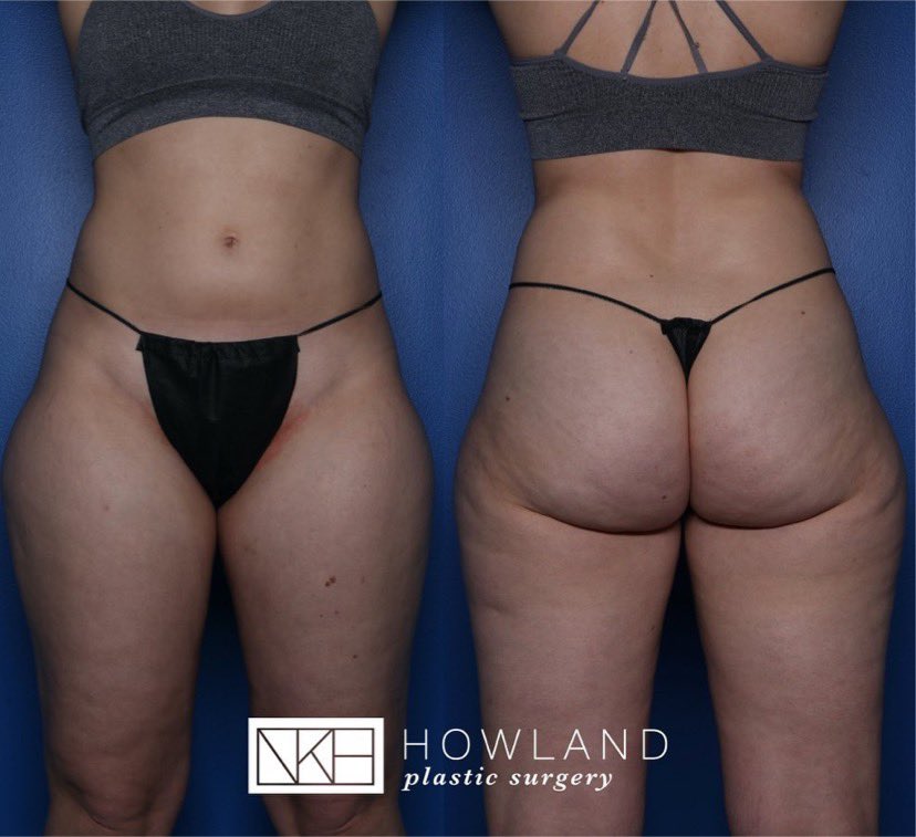 This is an example of someone with an excellent frame pre-surgery. Her WHR was already less than 0.7. ( You can see her hips from the front)