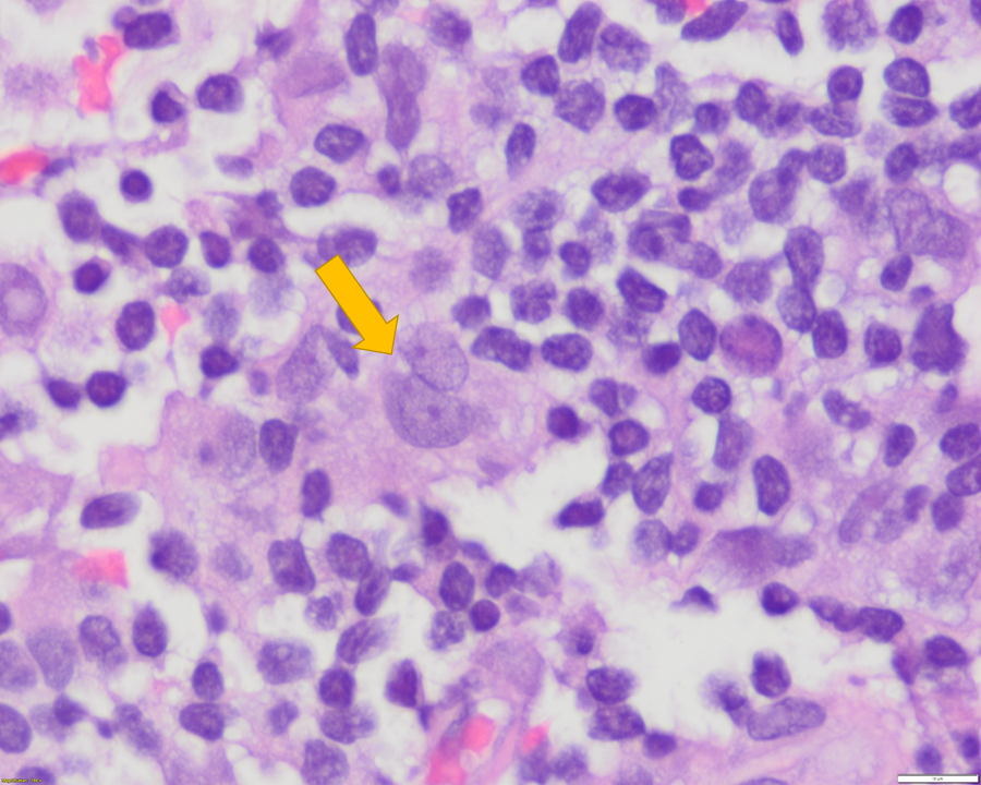sanamloghavi's tweet photo. The "kissing" nuclei of follicular dendritic cells.. this is what you read about in textbooks. 

Note the delicate nuclear chromatin and small central nucleoli.  #hemepath #HemepathMDA https://t.co/9ayvsk4DVc