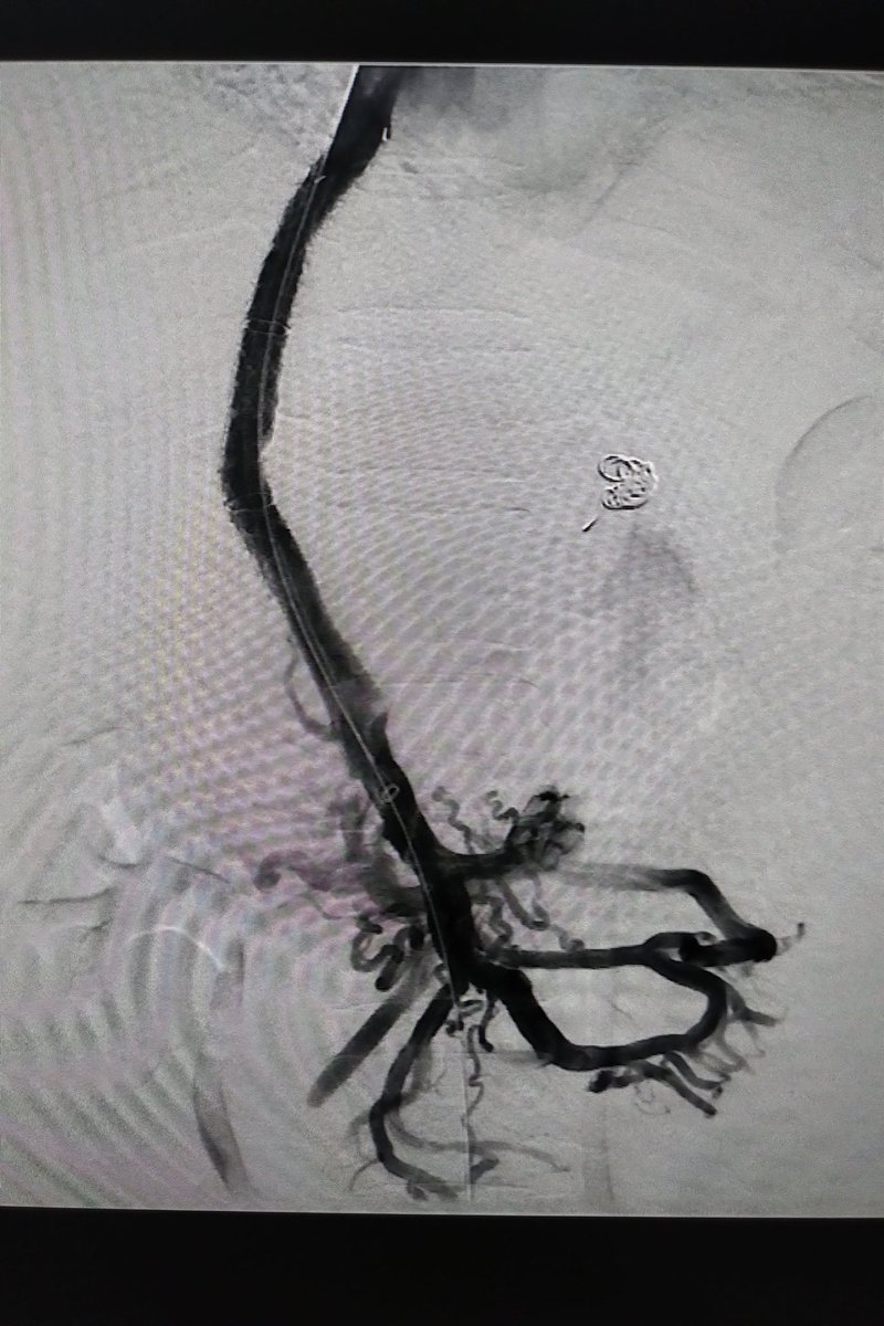 Pre and post images. Portal vein patent. @SIRspecialists @cirsesociety @SIRRFS @AASLDtweets @EASLnews