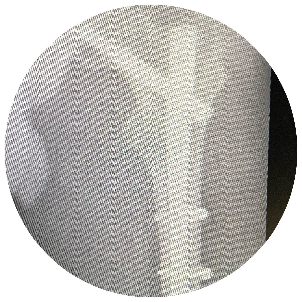 DrStefanieW's tweet photo. After a nasty double femur fracture and orthopaedic surgery in France (thank you to the great medical team!), we just got our son back to the UK. #Relieved - what a week...
#son #dermatologist #dermatology #family #fracture #me #SkinHealth #Eudelo https://t.co/pevHn6PaFB