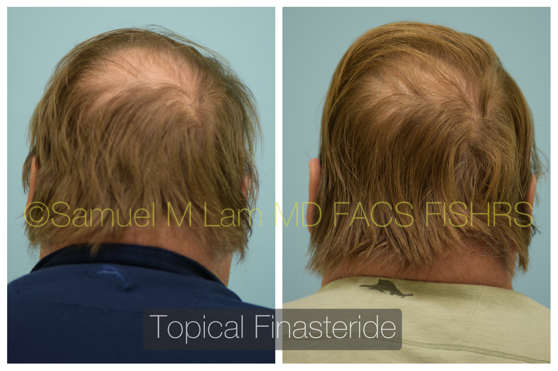 Where can i get finasteride in ireland