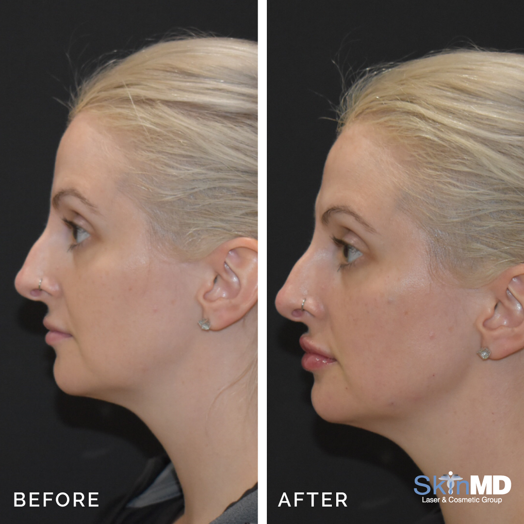 skinmdBOS's tweet photo. #FillerFriday ! These lips look simply stunning!! 2 syringes of Juvaderm Ultra Plus
Book your consultation today! #lipinjections #beforeandafter #skinmd #medspa https://t.co/muVMnrF0Is
