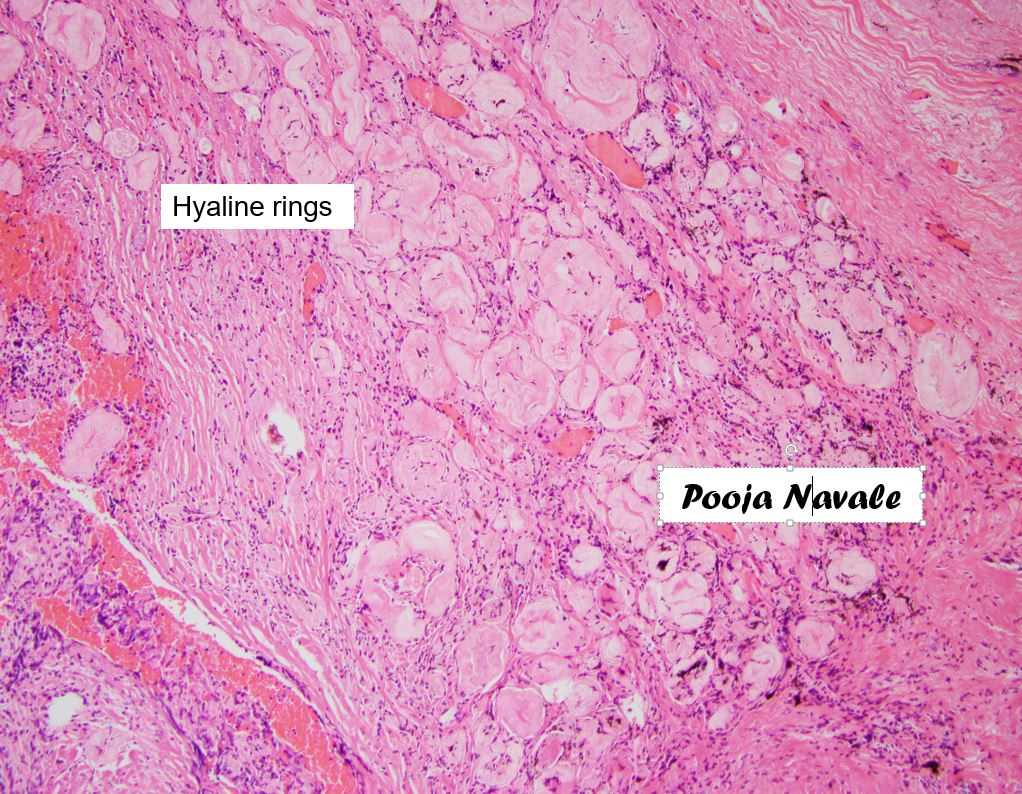 1/3 How I do not like to see perforated diverticulitis but when I see these- it lights up my day #GIpath #pathboards