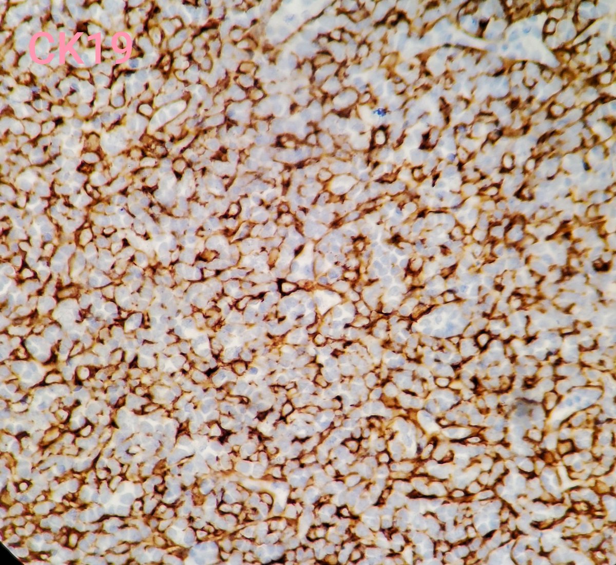 Case of the day: Mediastinal mass in a 80 year old male with history of melanoma. Mass is encapsulated, frozen section shows lymphoid proliferation, flow cytometry detects CD4/CD8 double expression cells.
