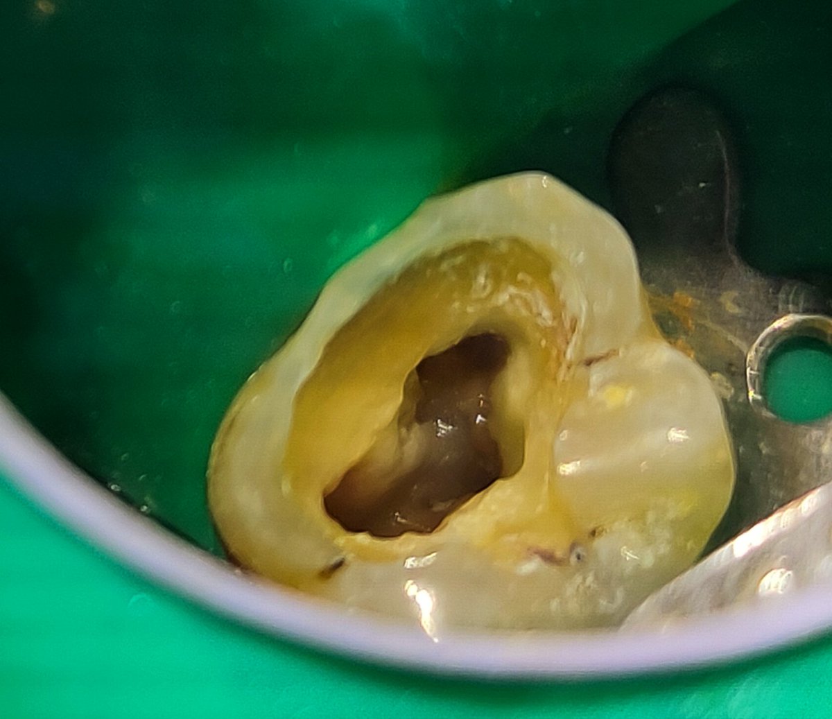 kh_helaly's tweet photo. MB2 in action 
#Upper6 
#Endo https://t.co/SIr6ld96uc