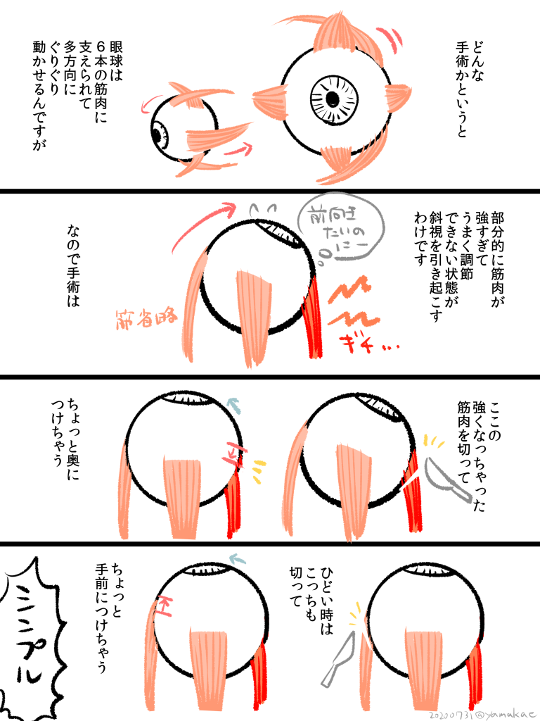 去年斜視の手術をしたので漫画にしました。(素人が先生に聞いた話をまとめたので間違っているところもあるかもしれません)手術は無事終わり今超快適ですありがたい… 