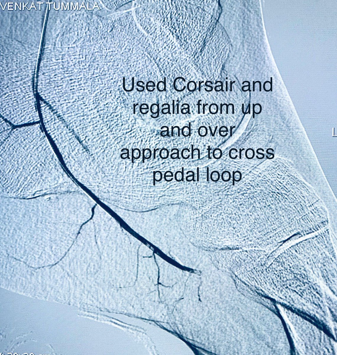 t_intheleadcoat's tweet photo. F/U from ☝🏾..PT improves and AT occluded before opens up distally.
Lateral plantar out. Pain relieved, numbness at the tip of toes persist.
Corsair, regalia to cross #pedalloop , PTA
Patient back to baseline.
Any method we take, not excluding distal vessel Rx options helps https://t.co/9e9Obe4HDh