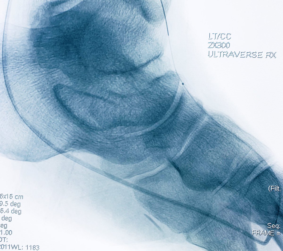 t_intheleadcoat's tweet photo. F/U from ☝🏾..PT improves and AT occluded before opens up distally.
Lateral plantar out. Pain relieved, numbness at the tip of toes persist.
Corsair, regalia to cross #pedalloop , PTA
Patient back to baseline.
Any method we take, not excluding distal vessel Rx options helps https://t.co/9e9Obe4HDh
