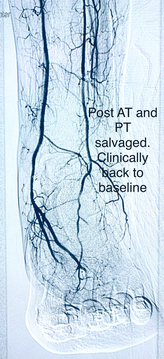 t_intheleadcoat's tweet photo. F/U from ☝🏾..PT improves and AT occluded before opens up distally.
Lateral plantar out. Pain relieved, numbness at the tip of toes persist.
Corsair, regalia to cross #pedalloop , PTA
Patient back to baseline.
Any method we take, not excluding distal vessel Rx options helps https://t.co/9e9Obe4HDh