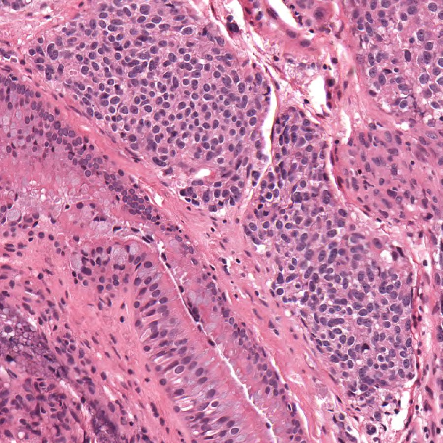 CraigHorbinski's tweet photo. Mass in the nasal cavity of a 65 year-old woodworker. Diagnosis? #pathology #neuropath #PathTwitter #headandneck #ENTpath #otolaryngology https://t.co/0pwuE348Xo