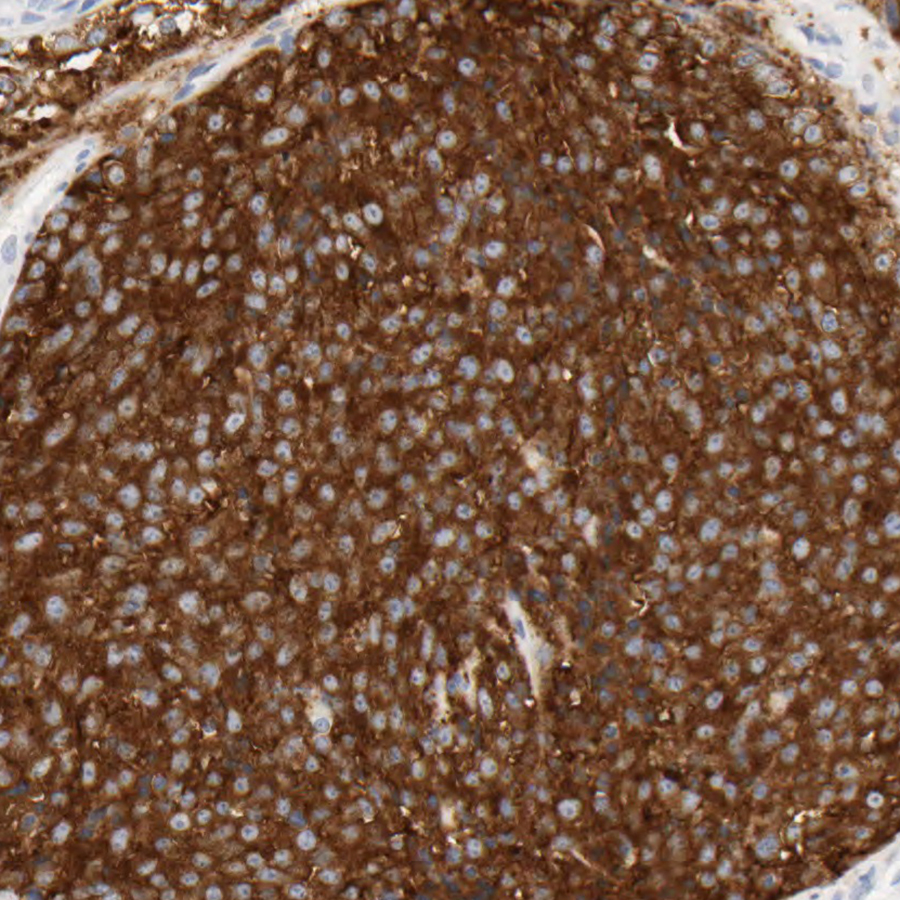 Mass in the nasal cavity of a 65 year-old woodworker. Diagnosis? #pathology #neuropath #PathTwitter #headandneck #ENTpath #otolaryngology