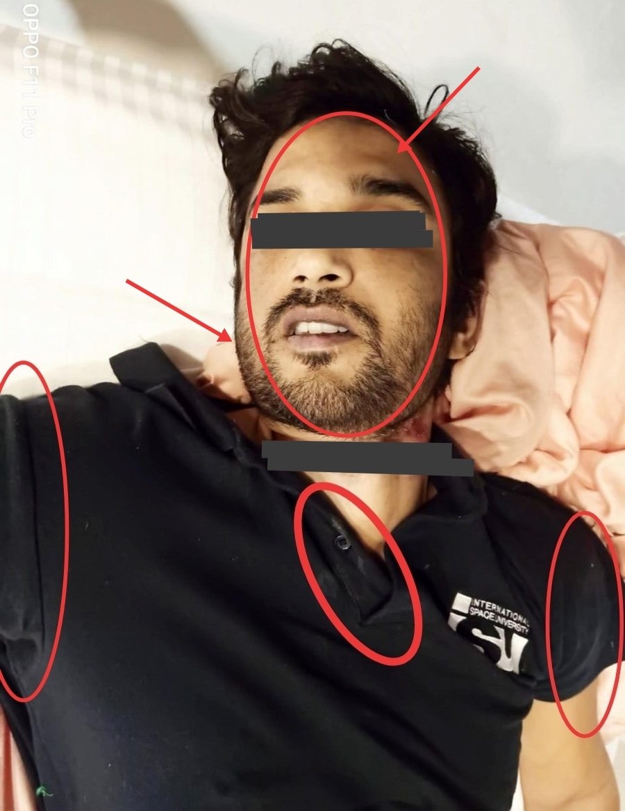  Was assaulted before got killed.Many things indicating that Sushant got assaulted before murder - Marks in t-shirts, Specially collar button (Could be rubbed in wall), Similar type of wall paint on both shoulders of t shirt. (Pic 1 original) #UddhavResignOrCBI4SSR