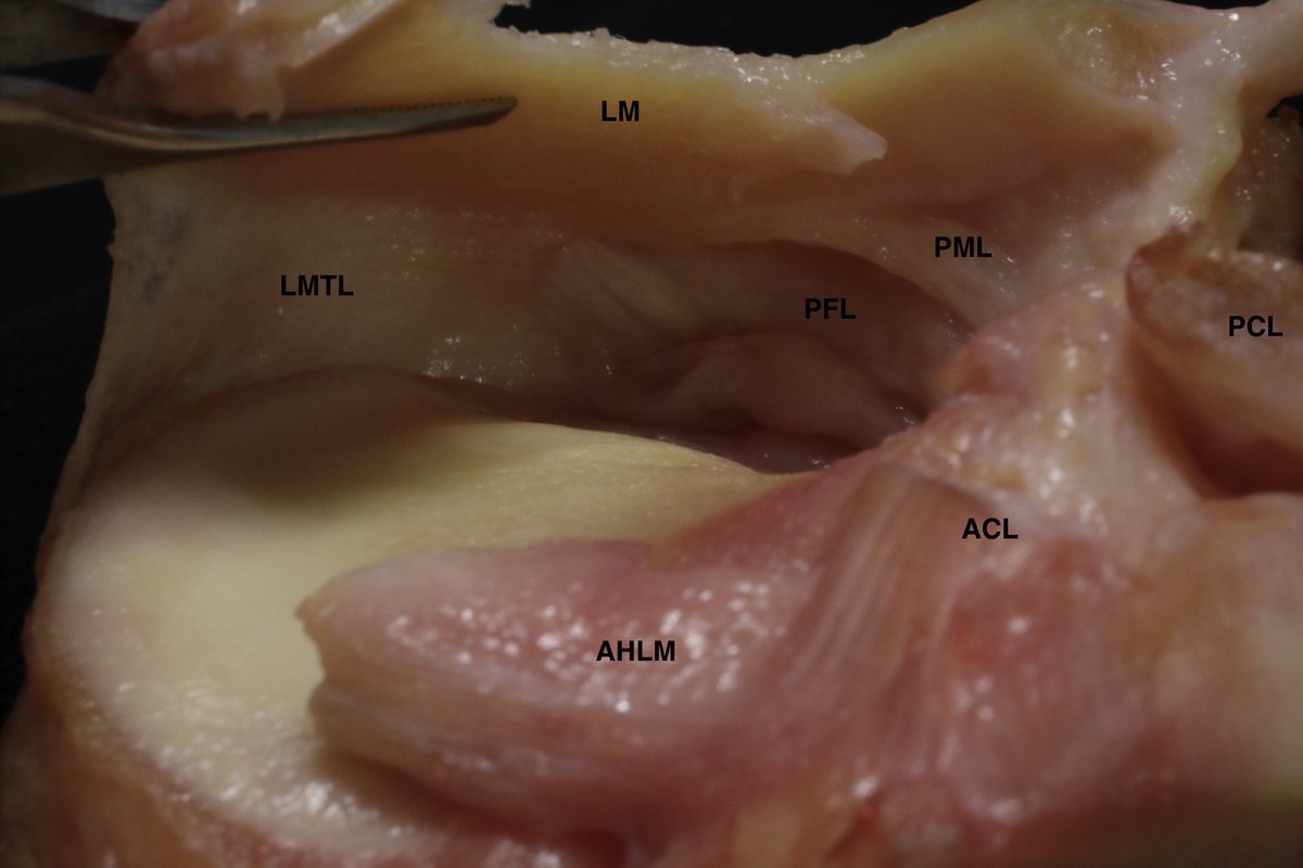ArthroscopyJ's tweet photo. Check out this interesting anatomic study that investigated the peripheral attachments of the lateral meniscal body https://t.co/A9hYi9vkho #posterolateralcorner #meniscusinjury #meniscussurgery https://t.co/EMYlFMS3En