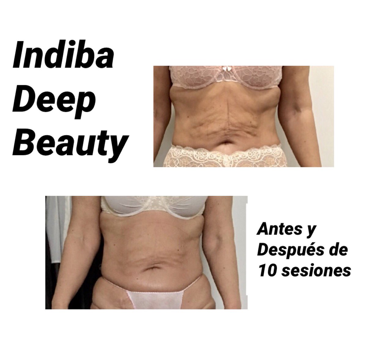 mculsanbeauty's tweet image. Hemos realizado 10ss de #tratamiento con la #avalada #Tecnología #indiba favoreciendo el #drenaje mejorando la #firmeza del #tejido #reafirmación aumentando el #metabolismo #celular estimulando la producción de #colageno y mejorando la #vascularizacion #indibadeepbeauty #inocuo