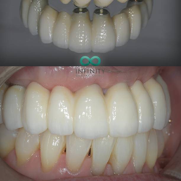 infinity_teeth's tweet image. One of the ways in which we replace a full arch of missing teeth using fixed dental implants and high strength zirconia...
Find out more at: infinitydentalclinic.co.uk/dental-implant…

#cosmeticdentist #dentalimplants #dentist #leeds #infinitydentalclinic #missingteeth #onlinebooking…