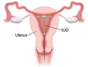 (I’m going to tell you folks: Things really usually can’t get past your cervix, even if you do have one and a uterus. Especially not a 2 inch steel ball. This is why you can’t “lose” tampons and such. You just gotta get up in there. It’s why IUDs are shaped like that.)